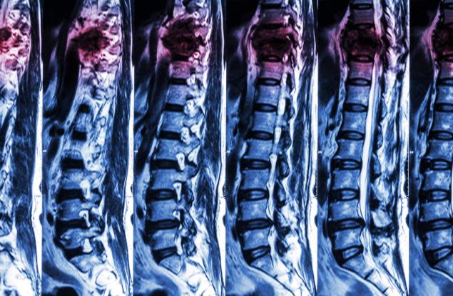 Потенциално антираково лекарство поправя и увредени нерви при травми на гръбначния стълб