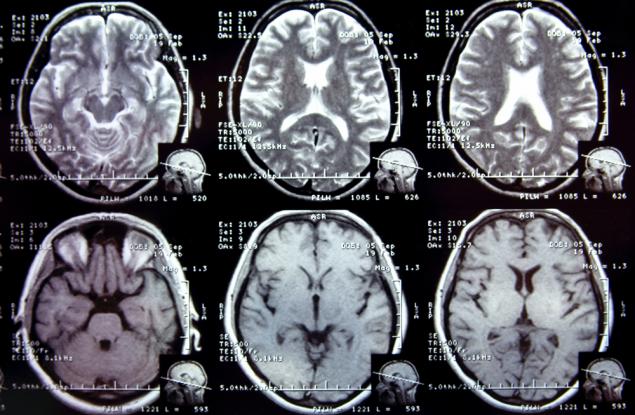 Започна търсене на нови маркери за откриване на мозъчните разстройства и тяхното лечение