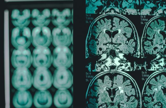 Ново лекарство забавя болестта на Алцхаймер
