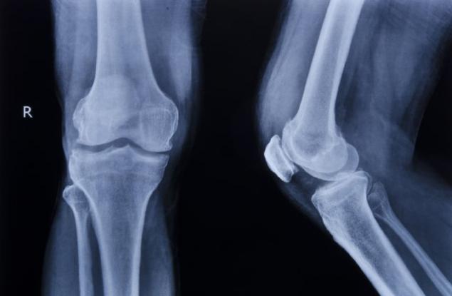  20 октомври - Световен ден за борба с остеопорозата 