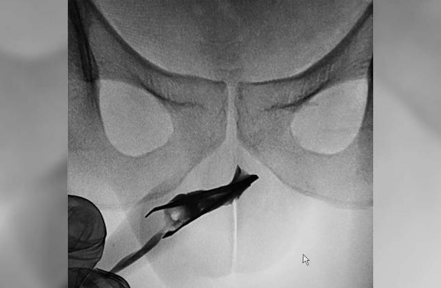 Мъж заклещи метални пинцети в своя пенис и не посети лекар в продължение на 4 години
