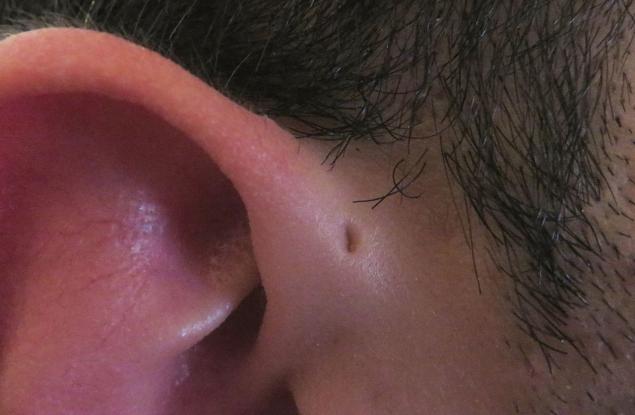 Защо някои хора имат малка допълнителна дупчица в ухото си?
