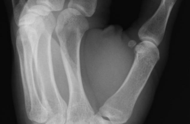 Рентгеновите лъчи са открити съвсем случайно