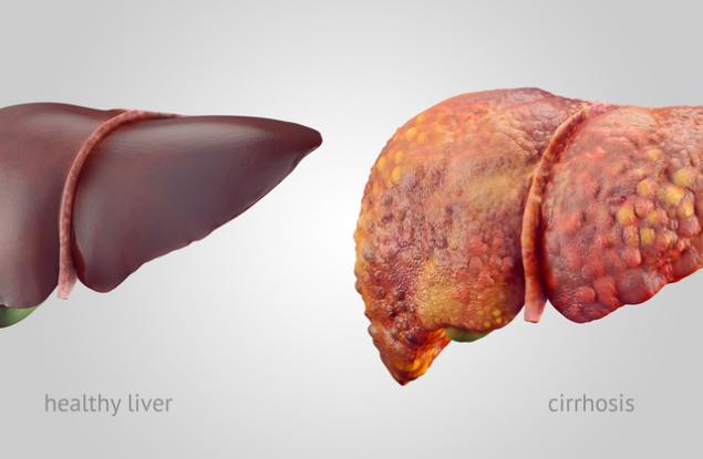 Вашият черен дроб може да се увреди от алкохол, дори и да не пиете