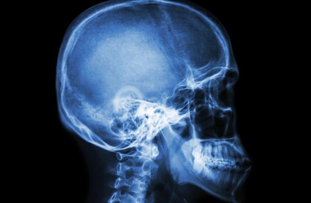 Нова медицинска технология принтира черепи по поръчка