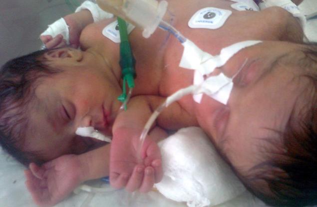 Родиха се сиамски близнаци с 3 ръце и общо сърце