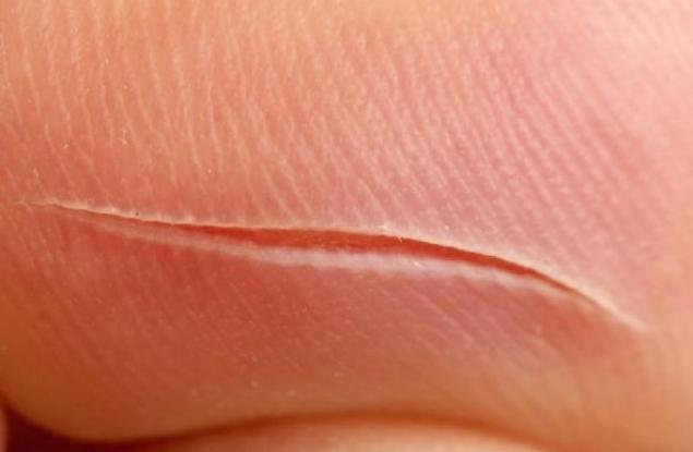 Учени откриха как да накарат раните да зарастват без белези