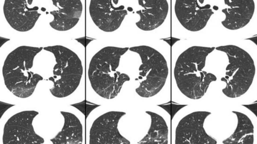 Ето какво се случва с белите дробове на хора с COVID-19