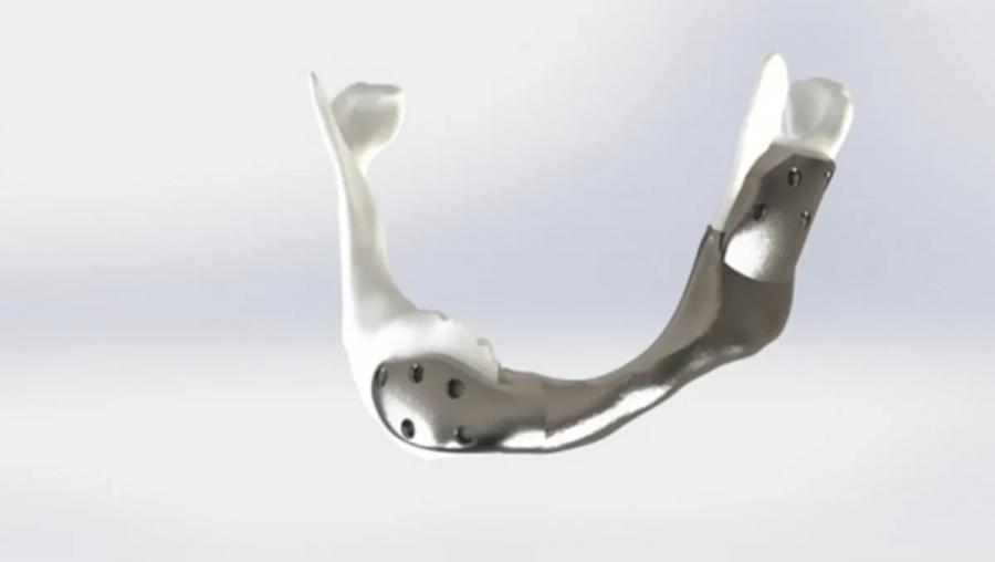 Пациент с рак получи първата в света 3D принтирана титанова челюстна кост