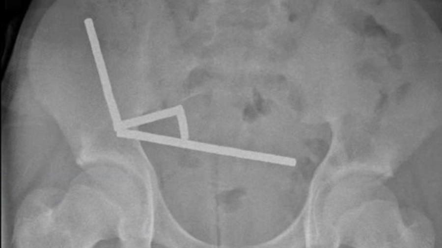 Тийнейджър загуби част от червата си, след като погълна близо 200 магнита