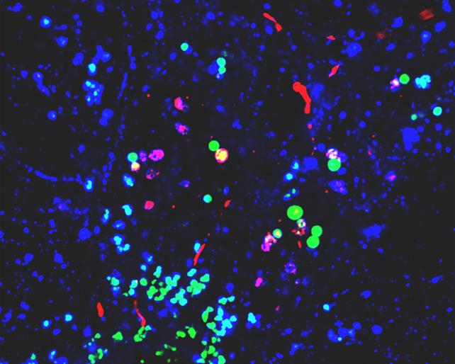 Нанопластмасите са свързани с промени в мозъчните протеини, асоциирани с болестта на Паркинсон