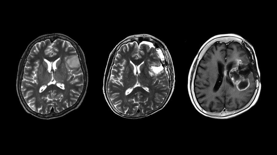 Пациентите с рядък вид астроцитом - тумор на неврона - имат по-лоша прогноза от очакваното