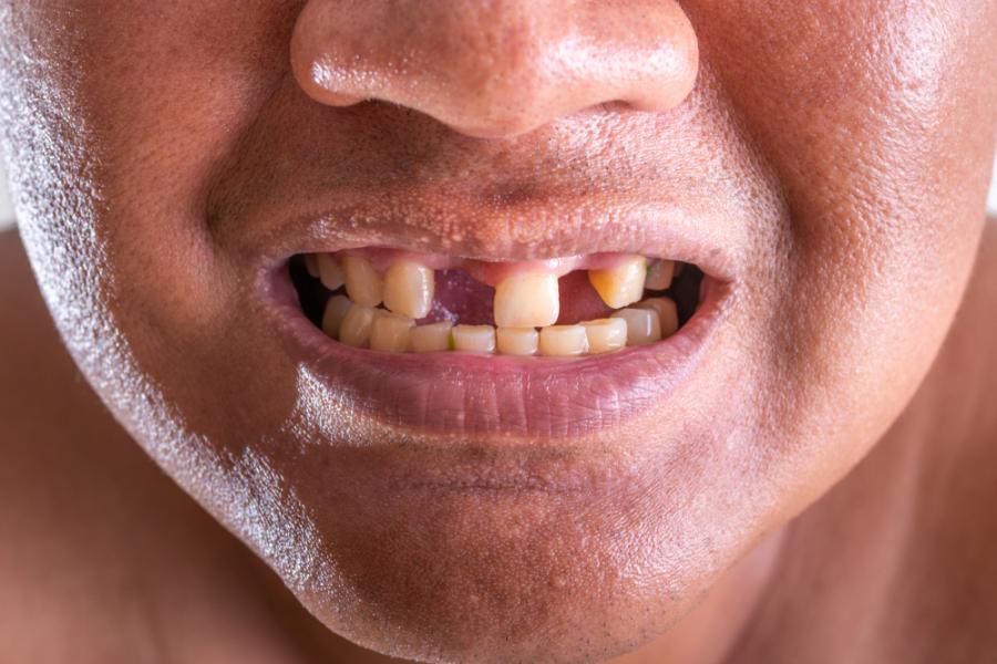 Учени откриха как да накарат зъбите да поникнат наново