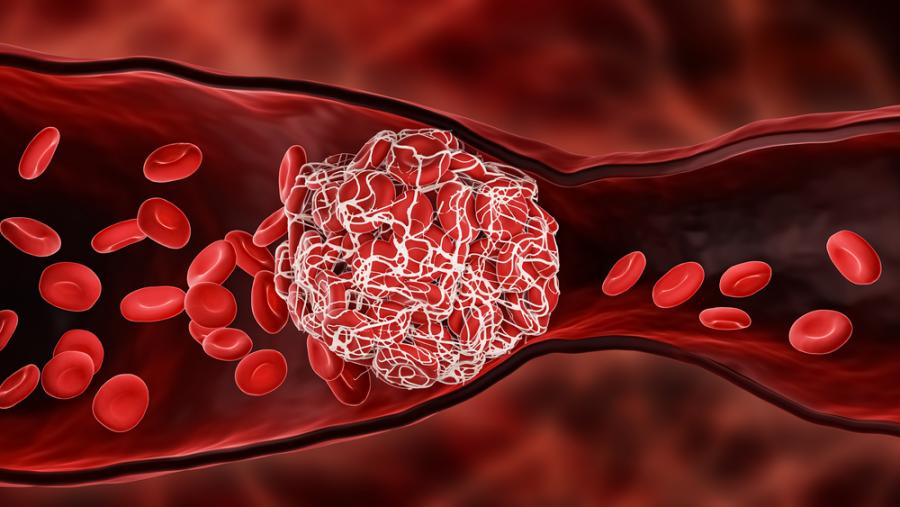 Изследване открива нови начини за предотвратяването на смъртоносни кръвосъсирвания