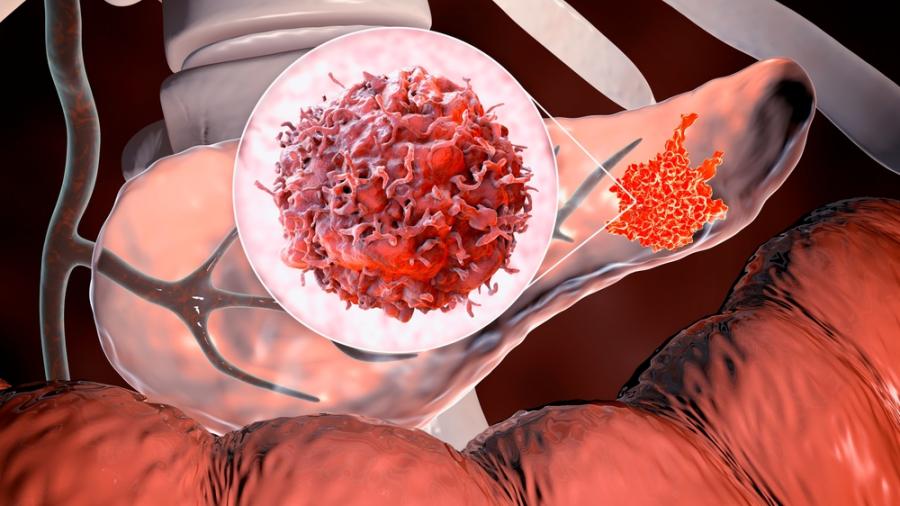 Нов дихателен тест може да промени из основи ранното откриване на рак на панкреаса