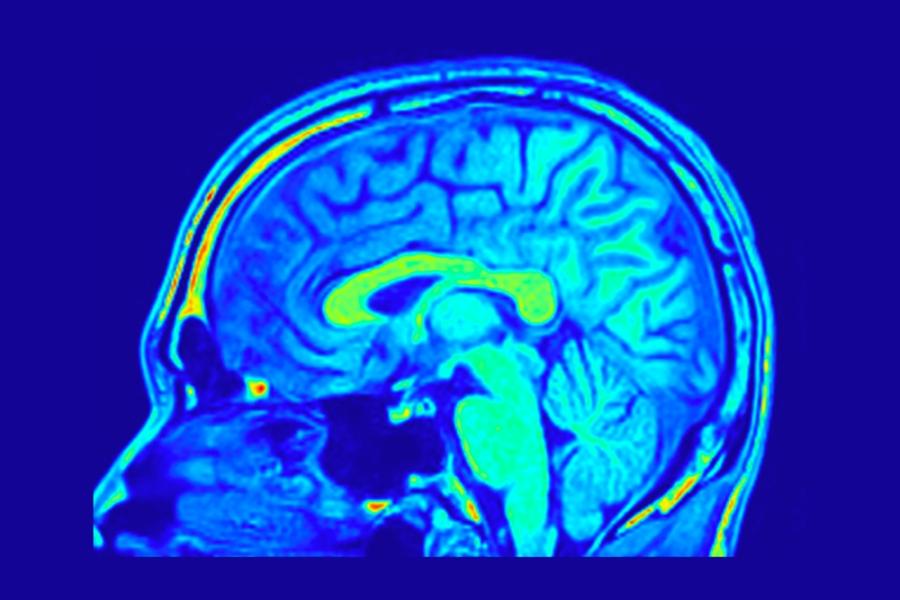 Промените във формата на мозъка могат да бъдат свързани с риск от деменция