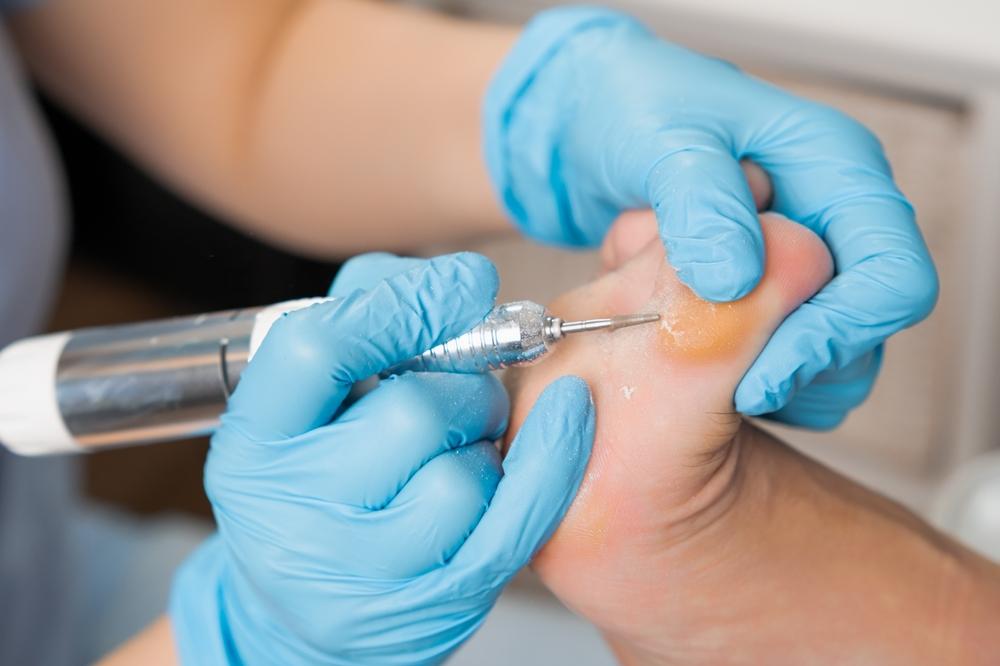 Мазолите - кога вече не са безопасни?