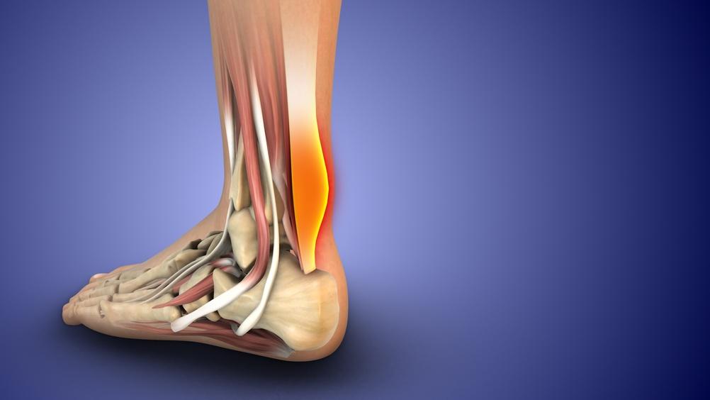 Болка в сухожилията: кои са най-честите причини и как да я облекчим?