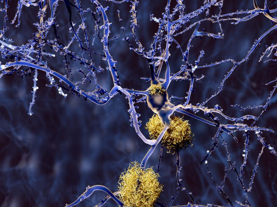 В битка с Алцхаймер – ново лекарство забавя развитието на болестта