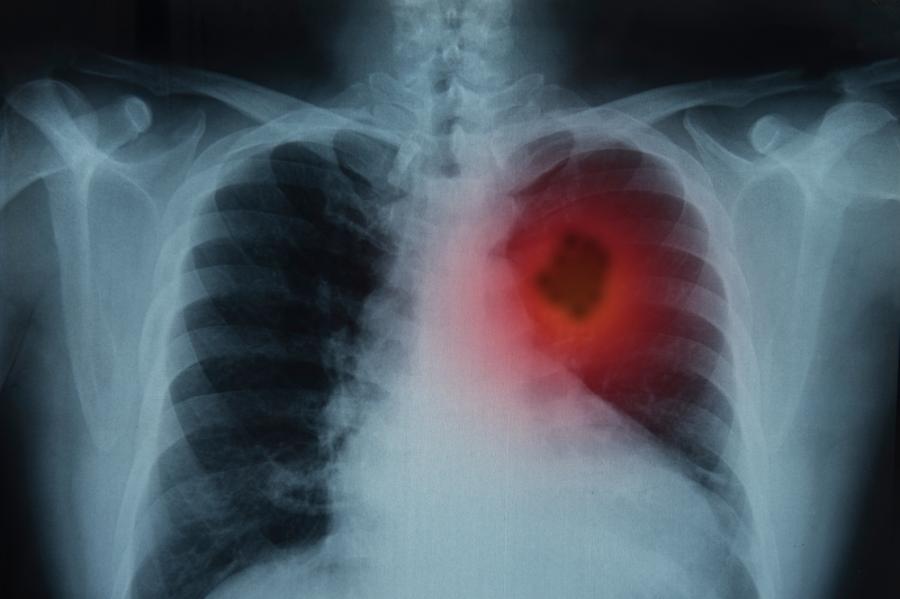 Ракът на белия дроб е сред петте най-често срещани видове рак