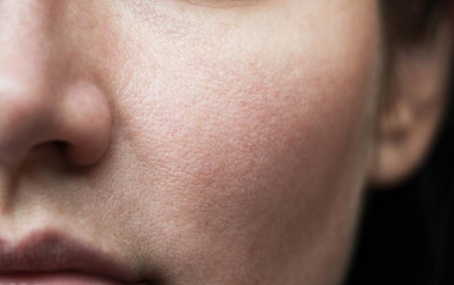 Дори нормално изглеждаща кожа може да крие рак