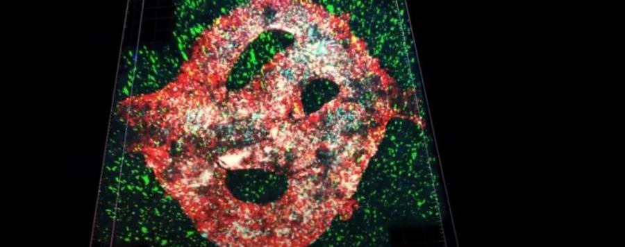 За първи път 3D принтираха смъртоносен тумор на мозъка в лаборатория