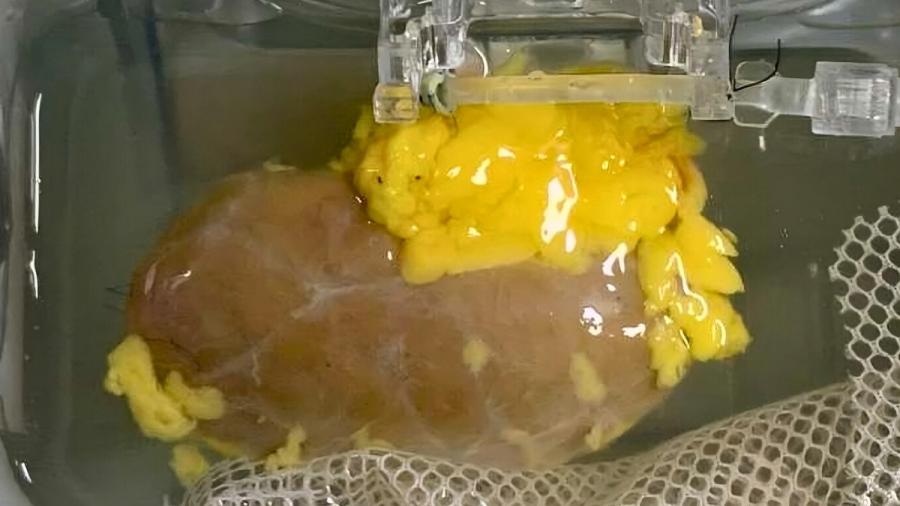 Пробив: Създадоха „универсален“ бъбрек, който пасва на която и да е кръвна група