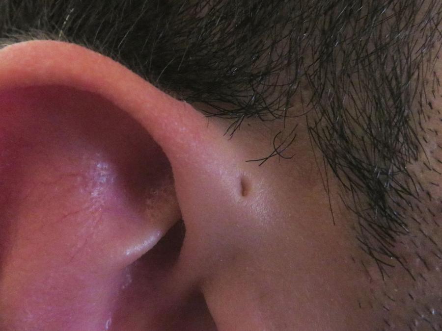 Защо някои хора имат малка допълнителна дупчица в ухото си?