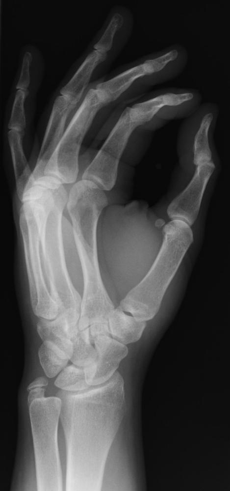 Рентгеновите лъчи са открити съвсем случайно