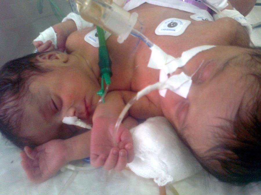 Родиха се сиамски близнаци с 3 ръце и общо сърце