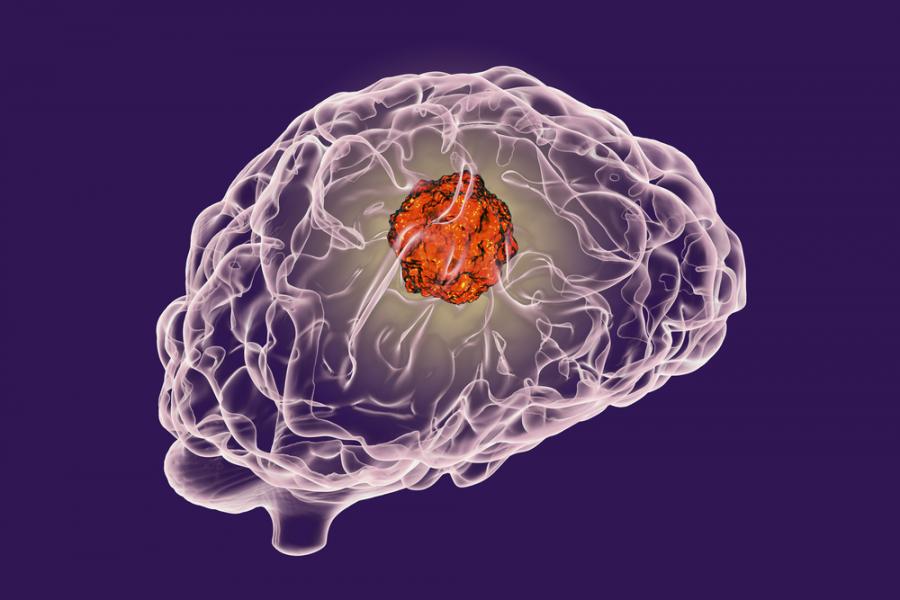 Проф. д-р Корай Йоздуман: 10 въпроса за мозъчните тумори