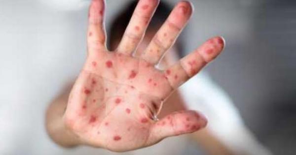 Над 2000 са регистрираните случаи на болни от варицела от