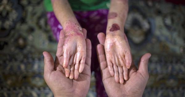 За първи път изключително рядко но крайно неприятно кожно заболяване