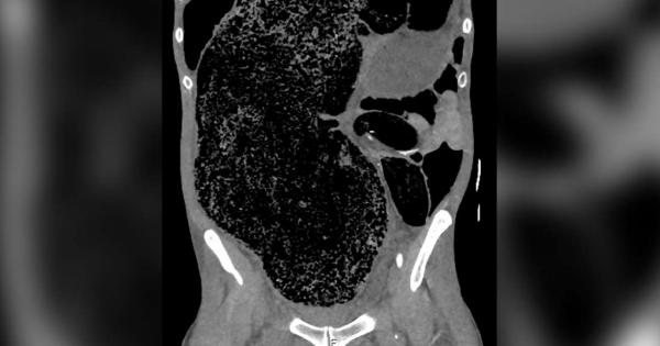 През 2018 та лекари в Австралия спасяват живота на мъж чийто