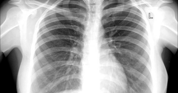 Туберкулозата е болезнено и хронично инфекциозно заболяване което засяга главно