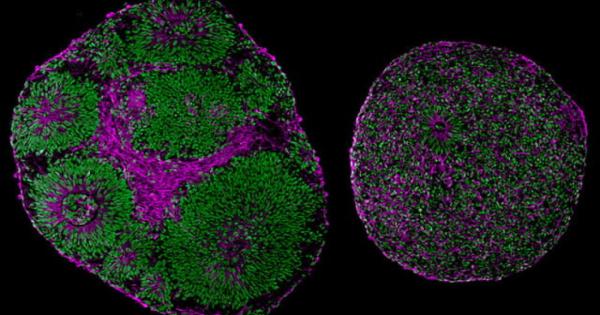 Учени откриха промени в неврологичната структура които вероятно лежат в