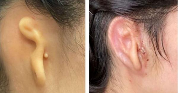 Медицински екип обяви че е успял успешно да имплантира тъкан