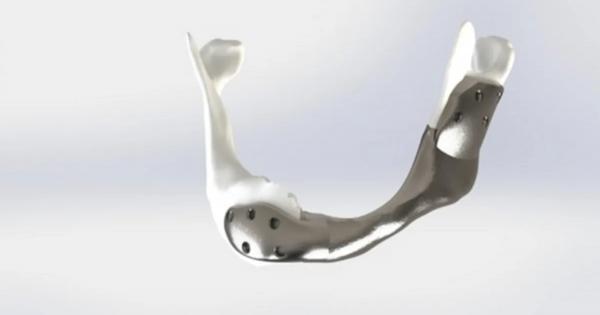 Титанова челюстна кост бе имплантирана успешно в главата и шията