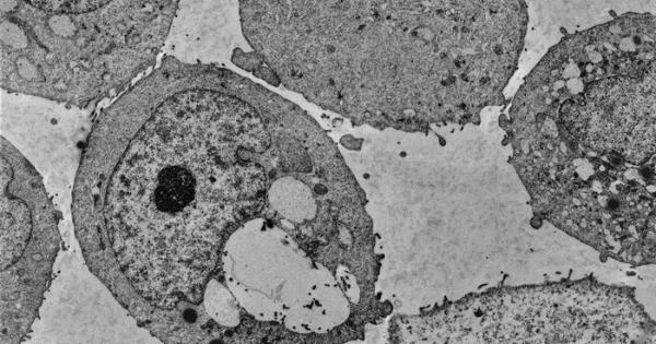 Ракът на простатата е тих убиец При повечето мъже той