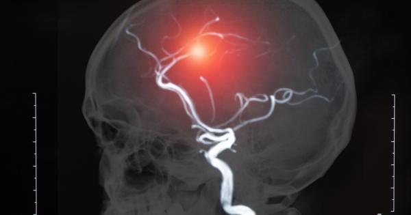 Мозъчните аневризми са нещо кошмарно – кръвоносен съд във вашия