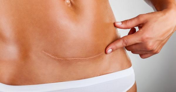 Втората ми бременност завърши с цезарово сечение и макар че