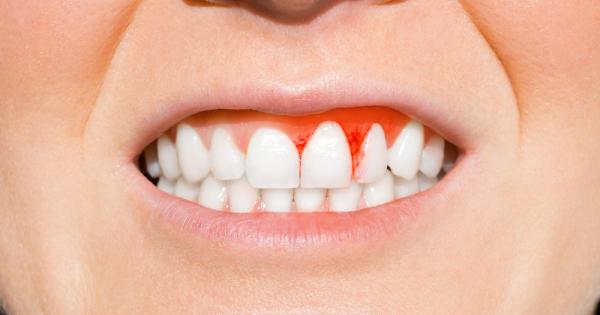 Заболяванията на венците са сред най честите хронични човешки заболявания – те засягат