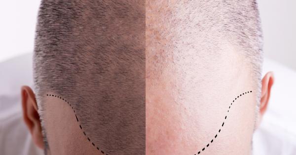 Въпреки че някои хора твърдят че плешивостта е новото секси