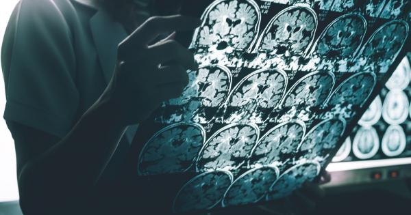 Болестта на Алцхаймер е сложно и трудно за разбиране заболяване