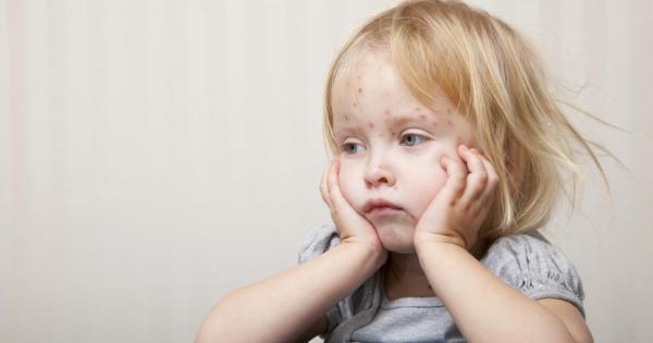 Варицелата е най заразната но същевременно лека шарка Детето разнася