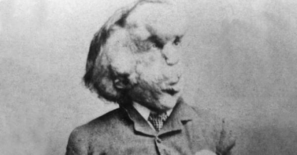 След близо 130 години останките на Джоузеф Мерик известен повече