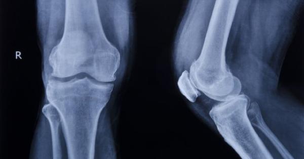 Световният ден за борба с остеопорозата се отбелязва ежегодно на