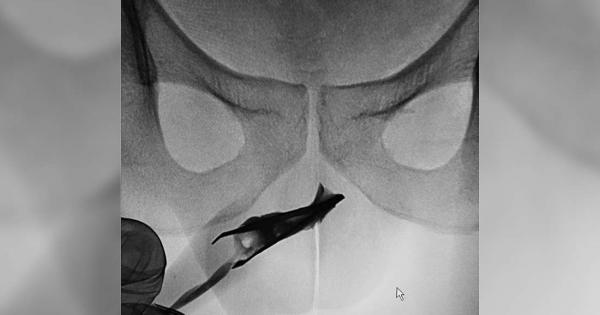 През 2015 г 18 годишен младеж решава да заклещи метални пинцети
