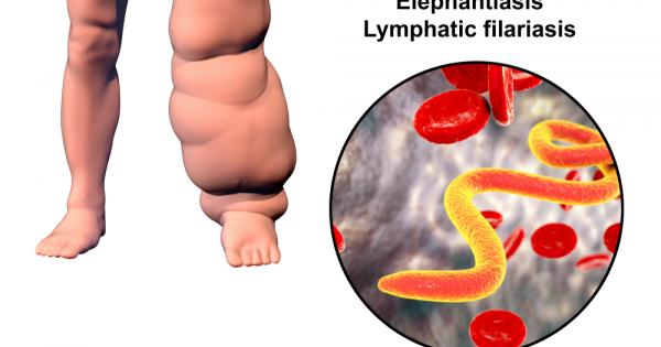 Причиняват я филариите на Банкрофт – паразитни червеи чиито личинки