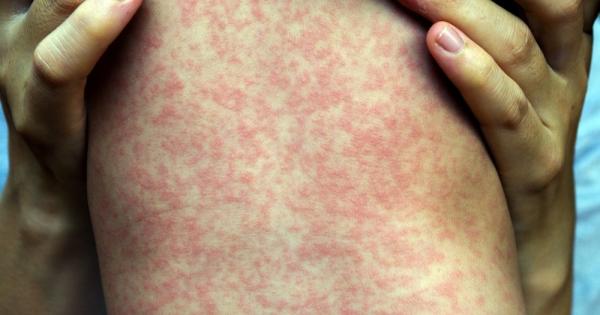 Дребната шарка елиминира спомена на имунната ви система за други